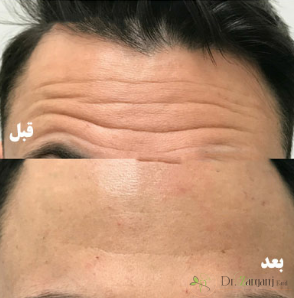 چه کسانی نباید بوتاکس کنند؟