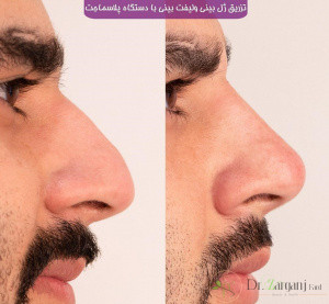 2: مزایا و معایب لیفت بینی با دستگاه پلاسما جت؟