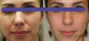 تزریق ژل برای چه مواردی استفاده می شود؟
