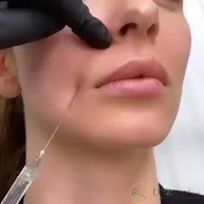 ژل خط خنده پرفکتا