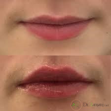 شیوه تزریق ژل لب