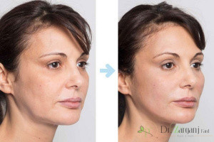 مزایای انجام لیفت صورت با نخ چیست؟