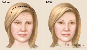 کاربردهای استفاده از عمل لیفت پیشانی چیست؟