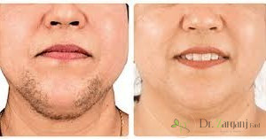 مزایای استفاده از روش لیزر موی زیر چانه چیست؟