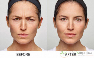 روش های تزریق بوتاکس مسپورت های تقلبی و اصل، کدام است؟