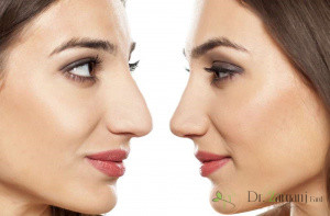 ماندگاری فیلر بینی چه مدت است؟