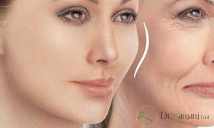 هزیه ی لیفت صورت با نخ به چه شکل می باشد ؟
