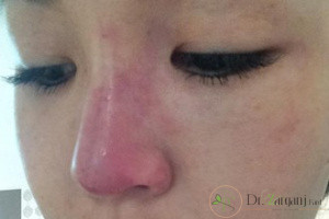 فرم دهی بینی با ژل چگونه صورت خواهد گرفت؟