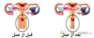 غیر از واژینوپلاستی آیا روش دیگری برای رهایی از مشکل گشادی واژن توصیه میگردد ؟