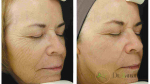 تزریق چربی در چگونه انجام می شود؟