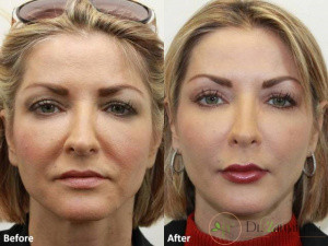 پیش از تزریق فیلر چه مراقبت هایی لازم است؟