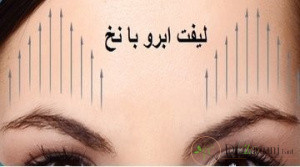 بهترین دکتر لیفت صورت با نخ