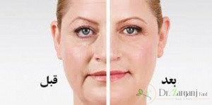 برایتان سئوال است که تاثیر ماندگاری ژل فیلر چقدر است ؟