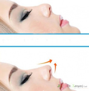 در لیفت بینی با نخ، چه نخ هایی مورد استفاده قرار می گیرند؟