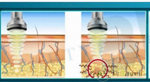عوارض لاغری با کویتیشن چه مواردی است؟