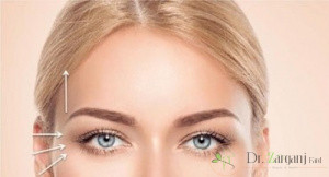 انجام جراحی لیفت برای شقیقه انواع مختلفی را دارد: