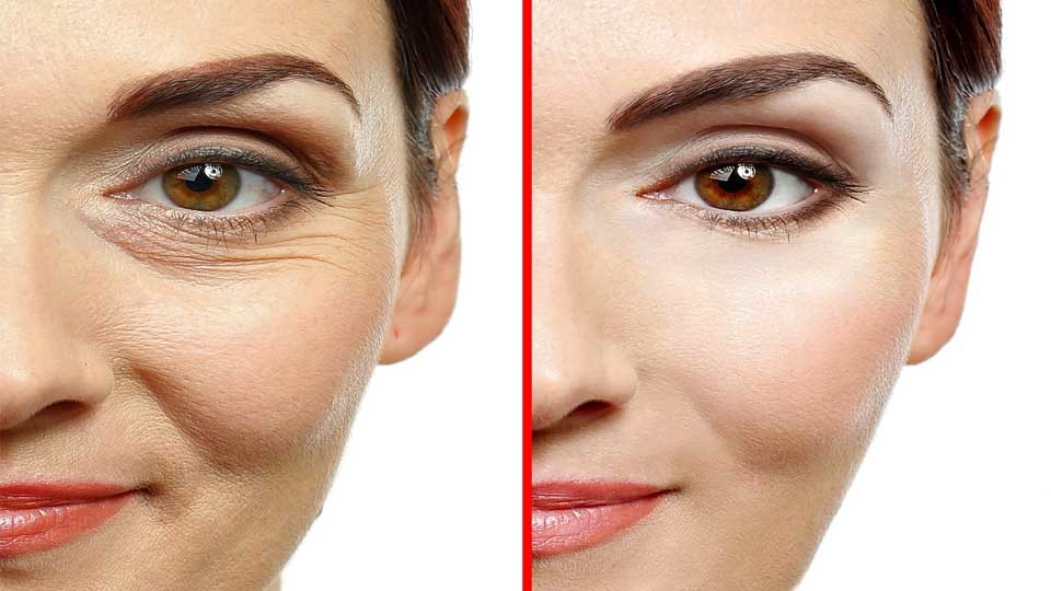 با هر بار تزریق بوتاکس ابرو چه تاثیری بر روی ماندگاری آن دارد؟