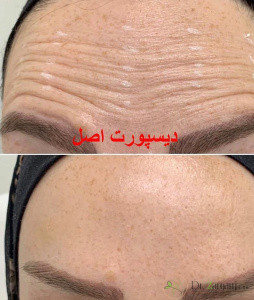 نظرات در مورد بوتاکس مسپورت