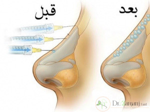 پس از تزریق ژل انجام چه مواردی ضروری است؟