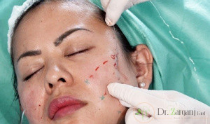 چه افرادی میتوانند از زاویه سازی صورت با نخ بهره ببرند؟