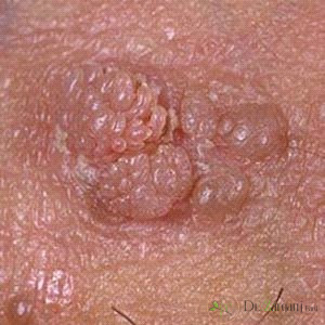علت بیماری تبخال تناسلی چیست؟
