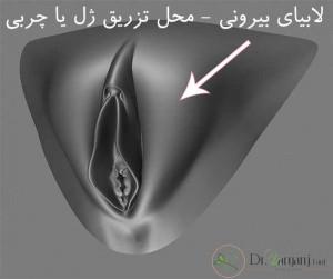 به چه علت چربی به لابیای ماژور تزریق می کنند؟