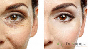 کربوکسی تراپی دور چشم چیست؟