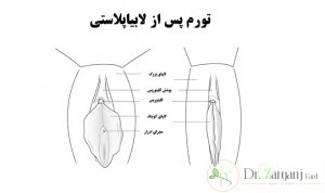 دستگاه تناسلی زنان دارای دو نوع لابیا است :