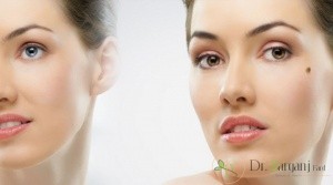 انواع خال و چگونگی جراحی آن در زنان چگونه است ؟
