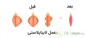 تورم بعد از عمل لابیاپلاستی چه مدت طول می کشد؟