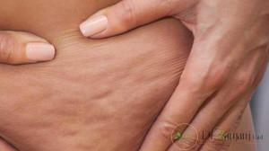 تاثیر کربوکسی تراپی برای لاغری به چه صورت است؟