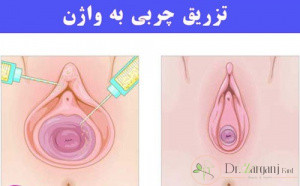 به منظور جوانسازی واژن تزریق چربی مناسب است یا تزریق ژل؟