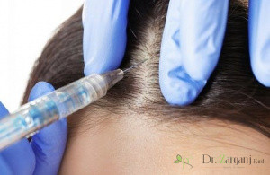 عوارض کربوکسی تراپی مو چه مواردی می باشد؟