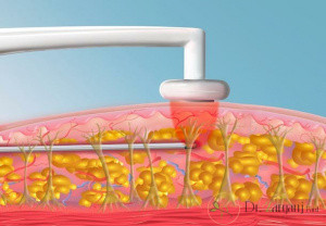 روش لیپوماتیک دارای چه مزایای است؟