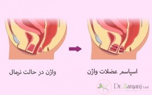 بهترین دکتر برای درمان واژینیسموس
