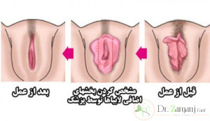 آیا از روش های انجام عمل لابیاپلاستی اطلاع دارید؟
