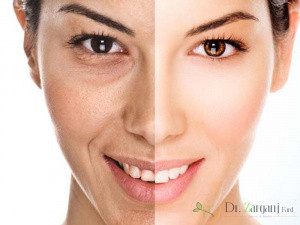 روش انجام کربوکسی تراپی دور چشم را عنوان کنید:
