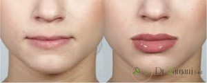 مراقبت بعد از تزریق ژل به صورت چگونه است؟