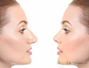 جراحی زیبایی بینی در بانوان به چه صورت می باشد ؟