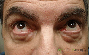 شما هم اطلاعاتی در رابطه با اقدامات قبل و بعد کربوکسی تراپی ندارید؟