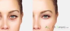آیا شما نیز با جراحی زیبایی بلفاروپلاستی آشنایی ندارید و از روش انجام آن اطلاعی ندارید ؟
