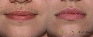 لیزر موهای زائد برای چه قسمت هایی از بدن انجام می شود؟