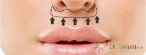روش لیفت گوشه لب در لیفت لب بالایی با نخ بر چه اساسی انجام خواهد گرفت ؟
