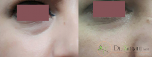 نحوه بی هوش کردن فرد در حین عمل تزریق چربی به چه صورتی انجام می شود ؟