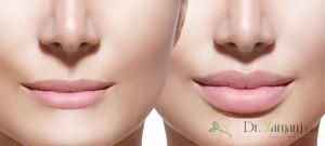 لیفت لب بالا با نخ به روش لیفت نخ از ناحیه پشت لب بالایی چگونه انجام می شود ؟