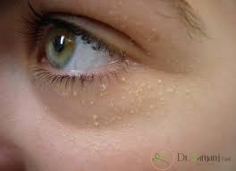بروز ضایعات کوچک سیرینگوما :