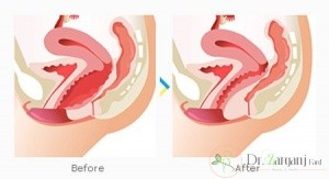 هزینه تنگ کردن واژن در ایران و خارج از کشور چه تفاوتی با یکدیگر دارد؟