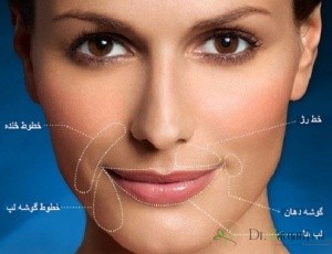 منظور از اصطلاح رایج « لیفت لب بالا با نخ » چیست ؟