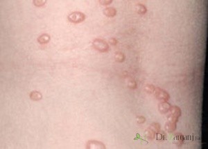 چه بیماری هایی ممکن است با زگیل تناسلی اشتباه گرفته شوند ؟