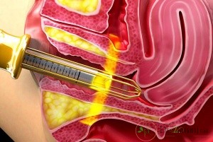  با تنگ کردن واژن به وسیله لیزر می توان چه مواردی را درمان کرد؟